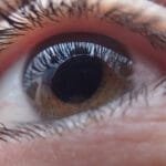 Glaucoma: Causas, Síntomas y Prevención